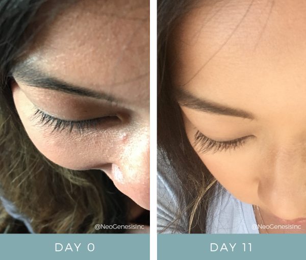 Before + After - Lash Loss