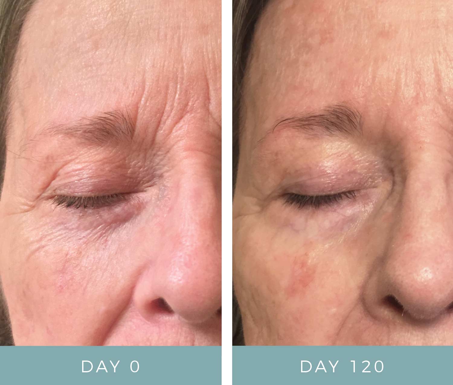 Before & After - Aging Skin