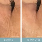 Before + After - Aging Skin - Crows Feet