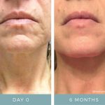 Before and After - Aging Skin