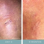 Before + After - Basal Cell Carcinoma