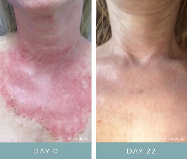 Before + After - Chemical Peel and Radiation