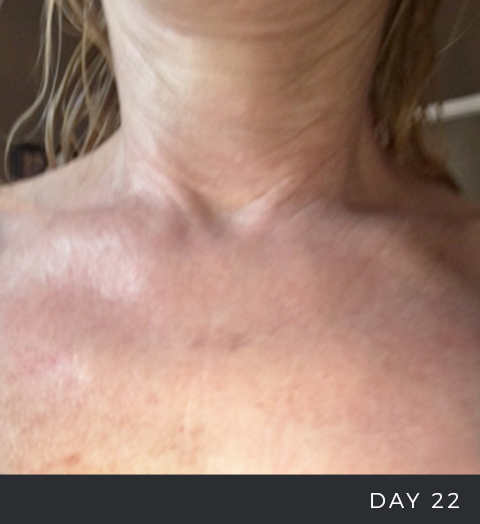 Before + After - Chemical Peel + RadiationBefore + After - Chemical Peel + Radiation