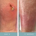 Before + After - Diabetic Ulcers