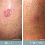 Before + After - Melanoma Surgery 