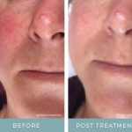 Before + After - Rosacea + Microcurrent