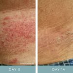 Before + After - Shingles