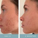 Before + After -Acne