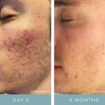 Before and After - Acne