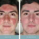 Before + After - Acne + Rosacea
