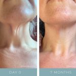 Before + After - Aging Neck
