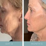 Before + After -Aging Skin