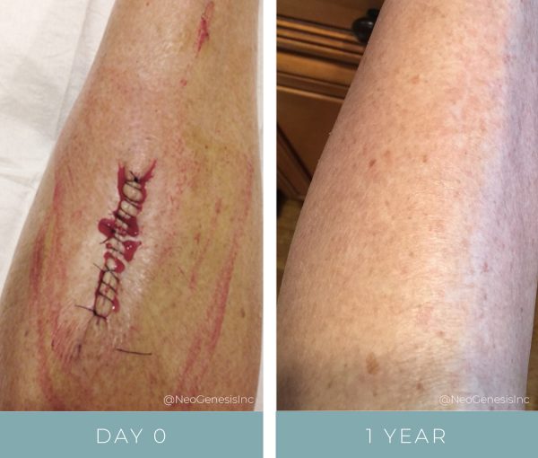 Before + After - Wound Care