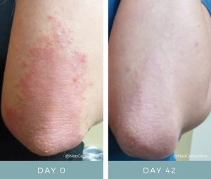 Before + After - Psoriasis