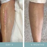 Before + After - Wound Care - Scarring