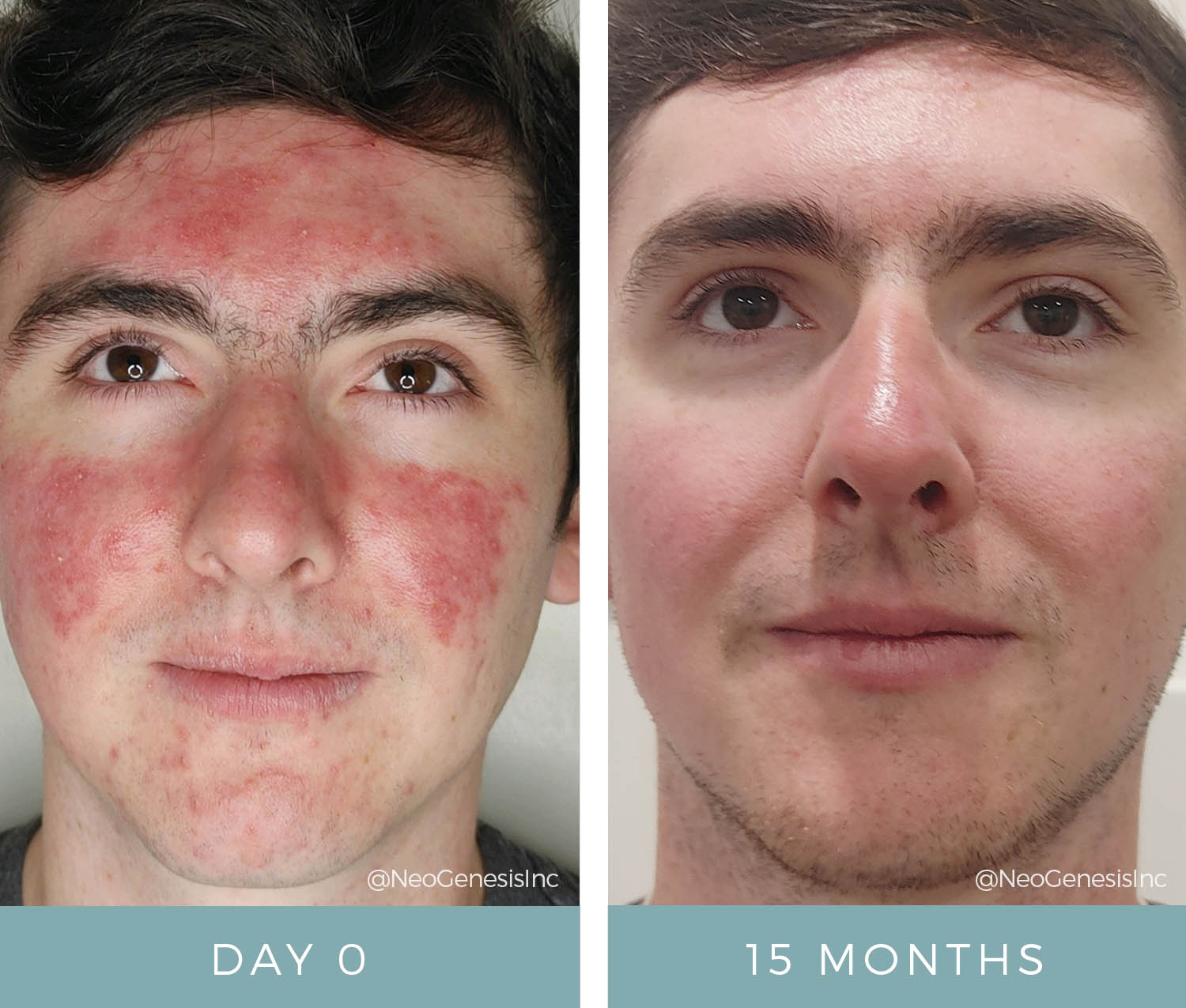 Oily + Problem Skin - Acne + Environmental Before + After
