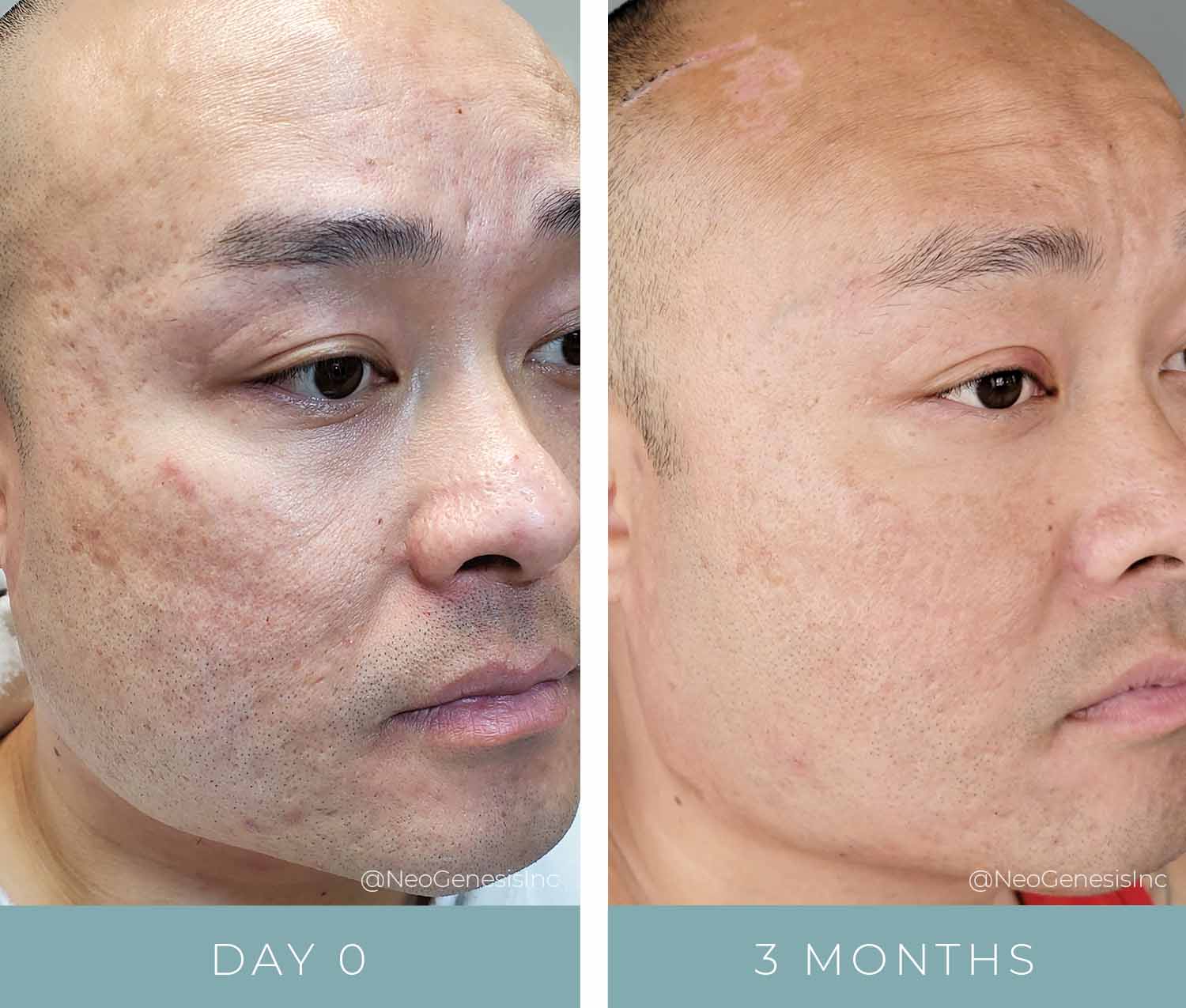 Before + After - Acne Scar Reduction