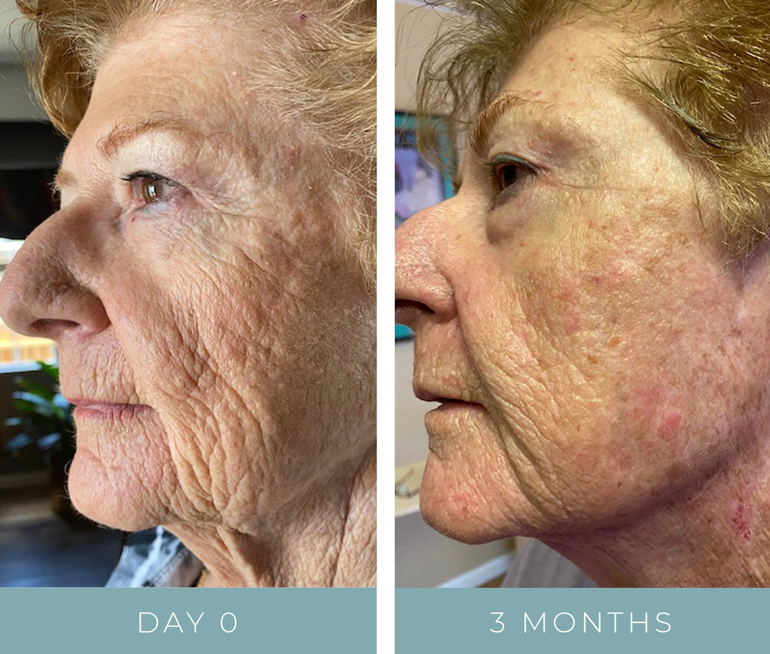 Before + After - Aging Skin