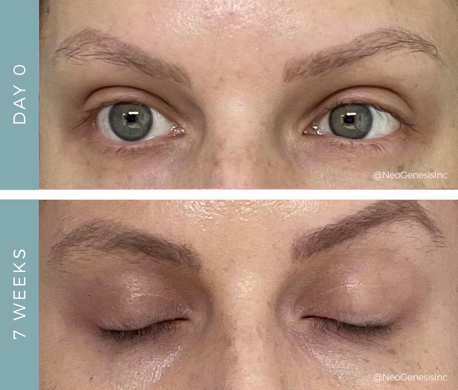 Before + After - Lash + Brow Loss from Chemo
