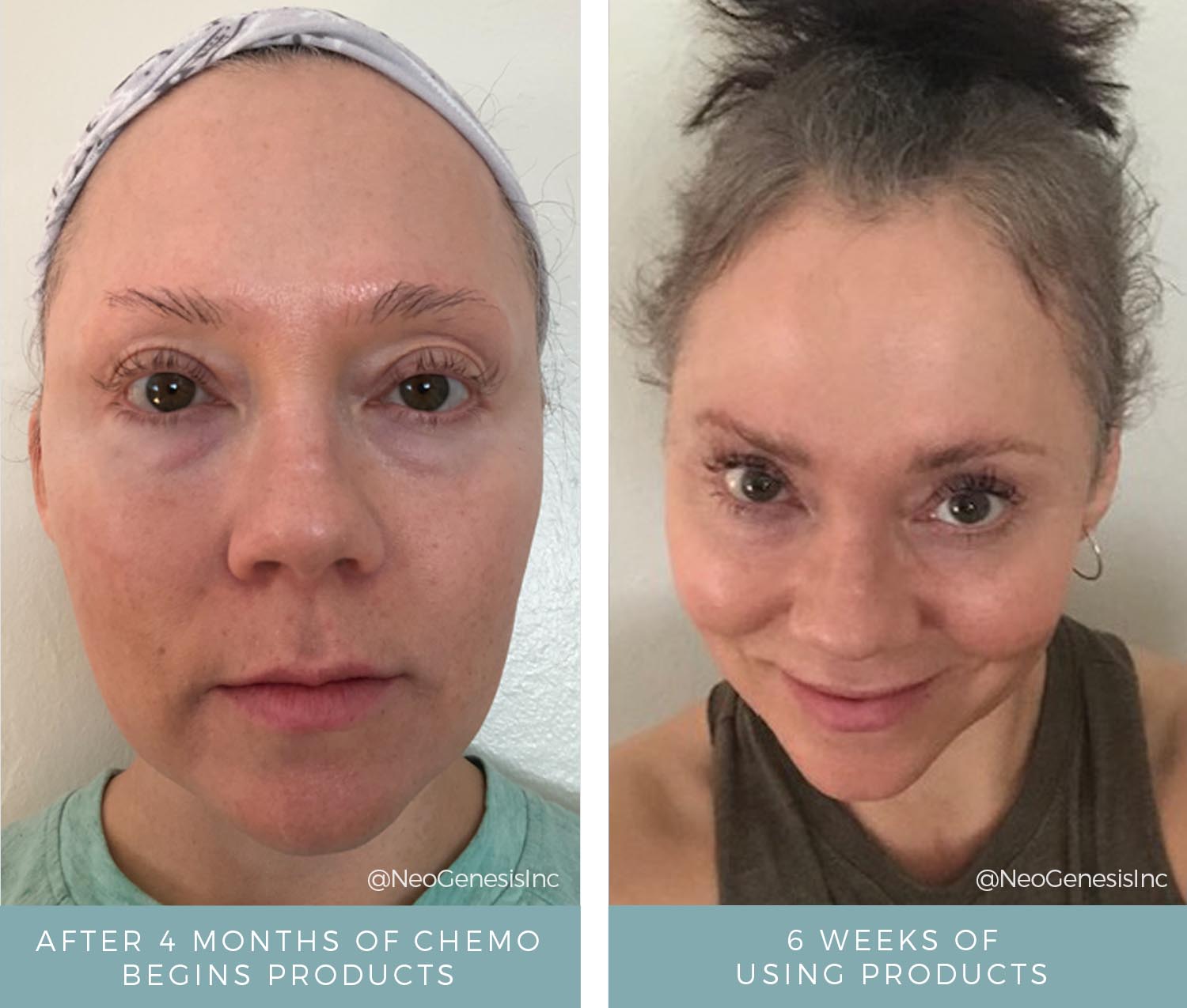Before + After - Chemo Hair + Lash + Brow Loss