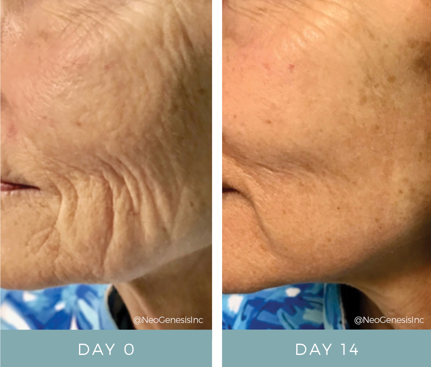 Fibroblast Before + After