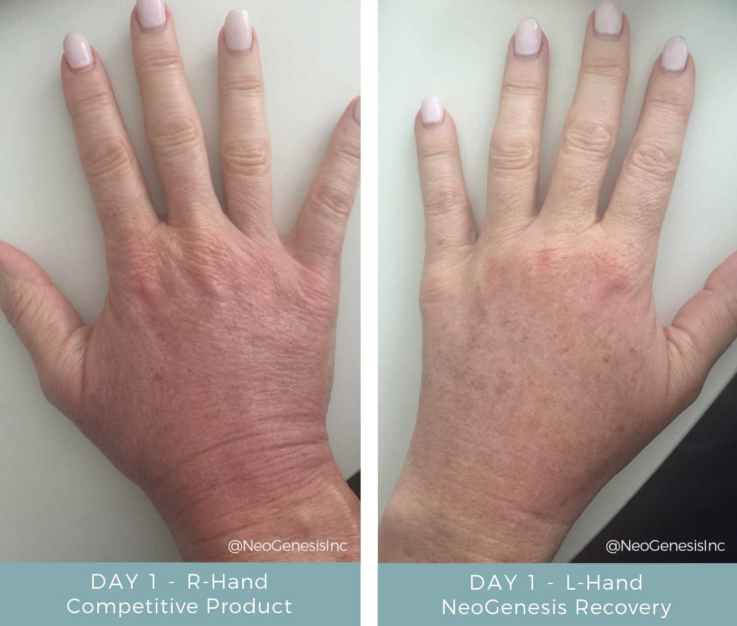 Before + After - Fraxel Laser treatment