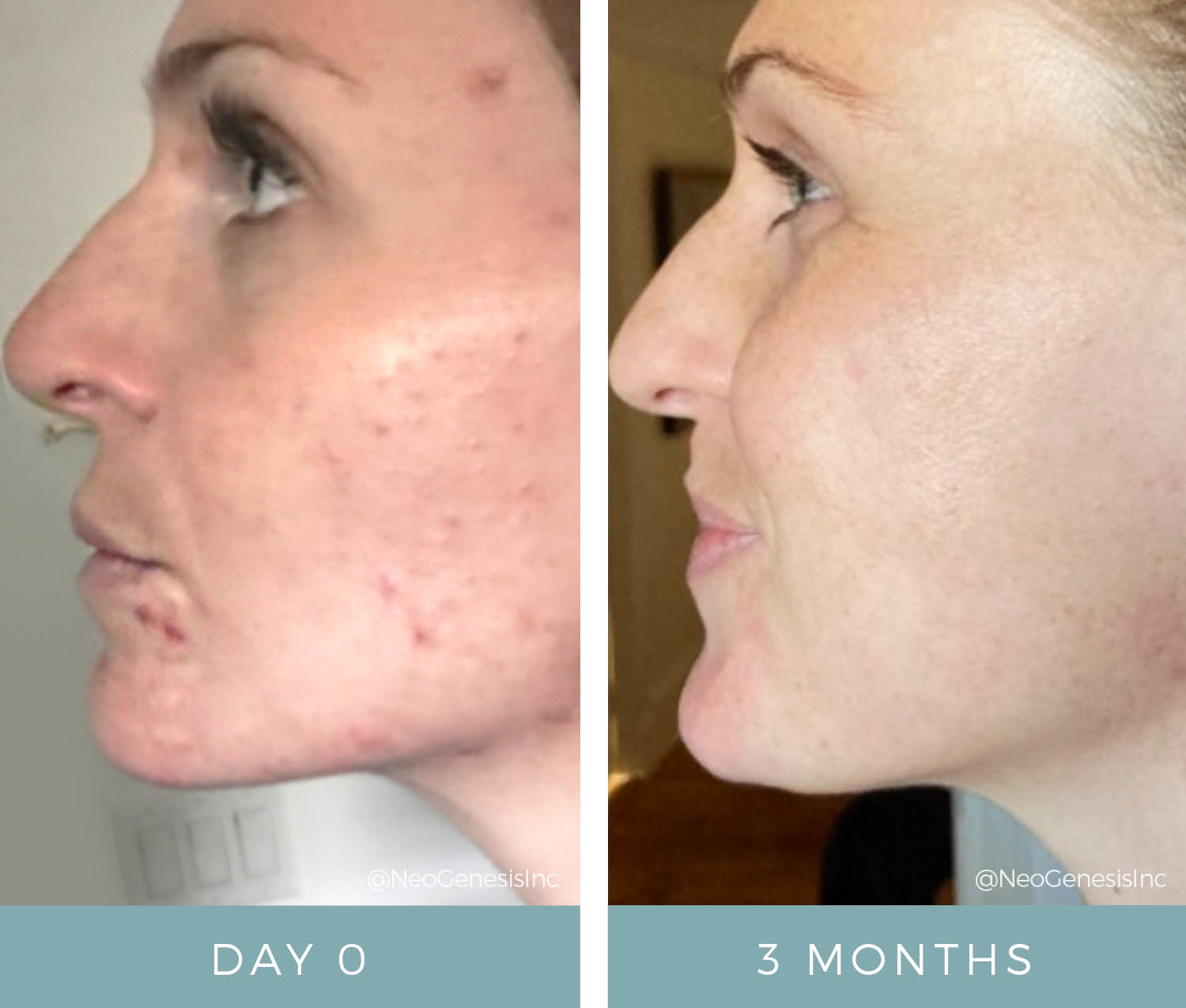 Before + After - Hormonal Acne