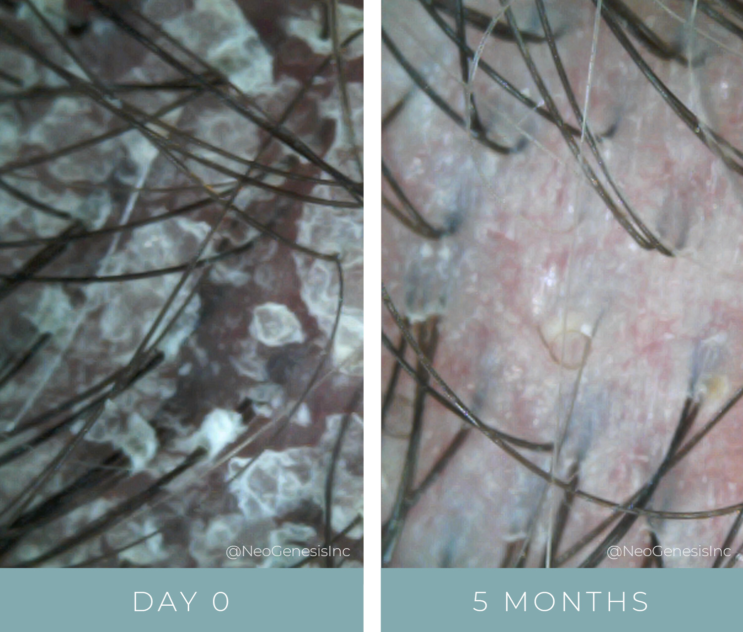 Before + After - Psoriasis on the scalp