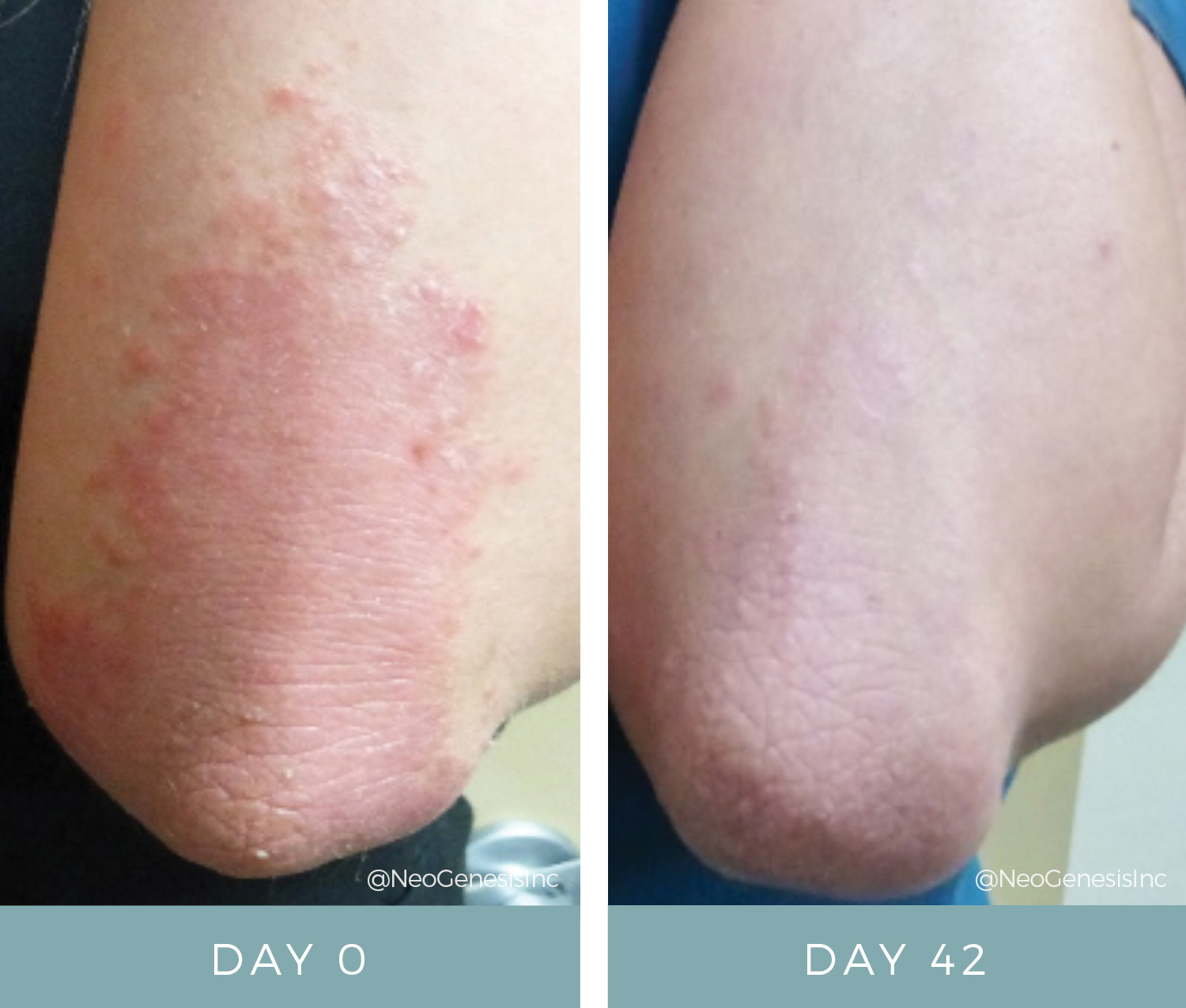 Before + After - Psoriasis on the elbows