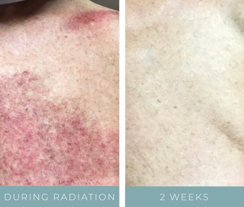 Before + After - Radiation