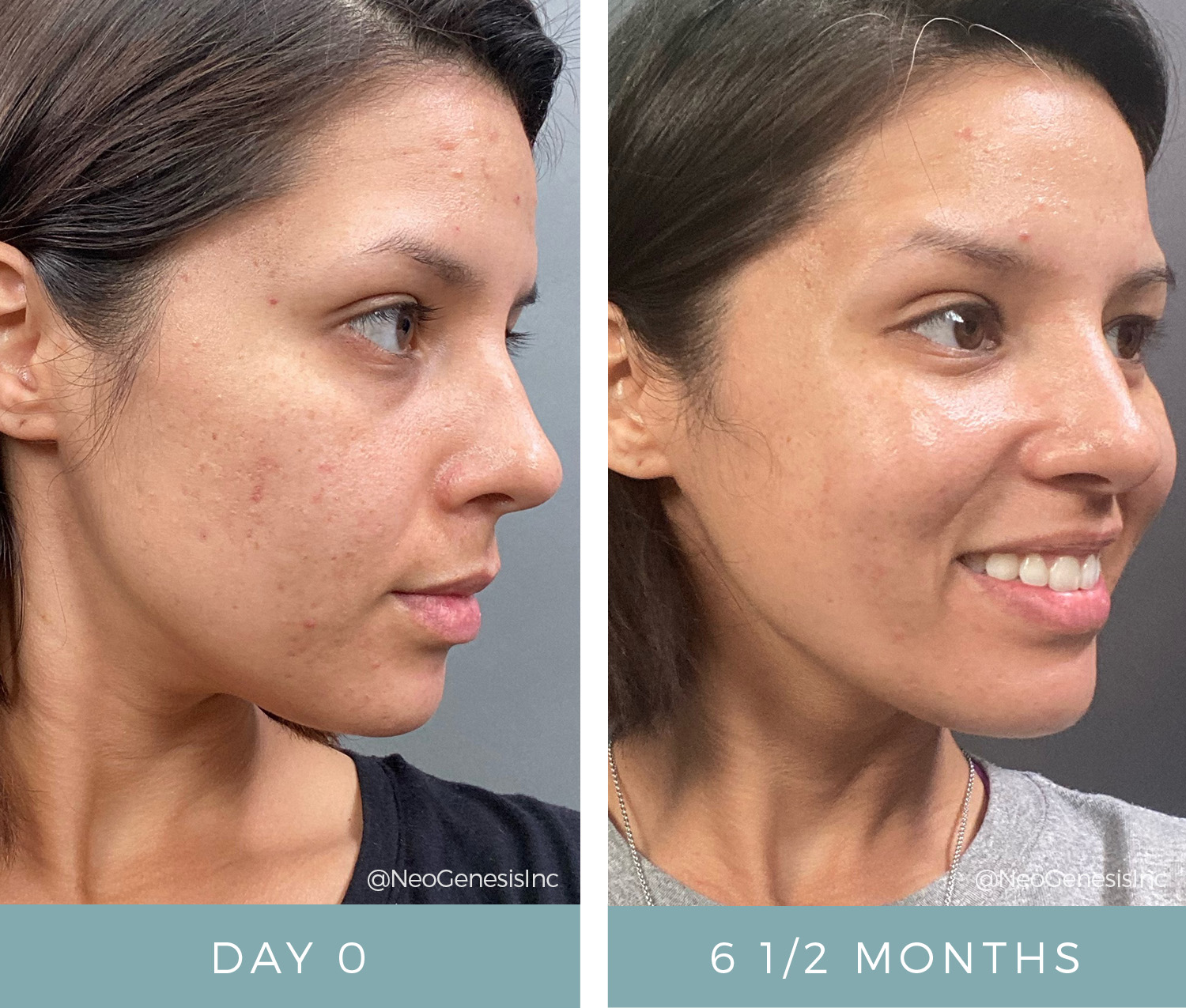 Before + After - Acne