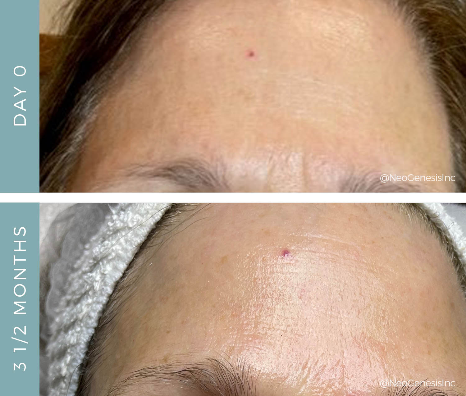 Before + After - Aging Forehead