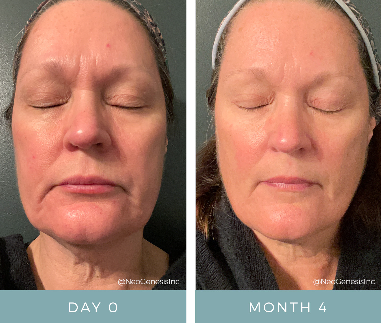 Before + After - Aging Skin, Eczema, Rosacea