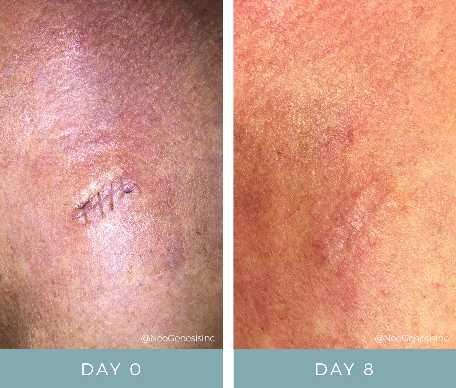 Before + After - Basal Cell Carcinoma Surgery
