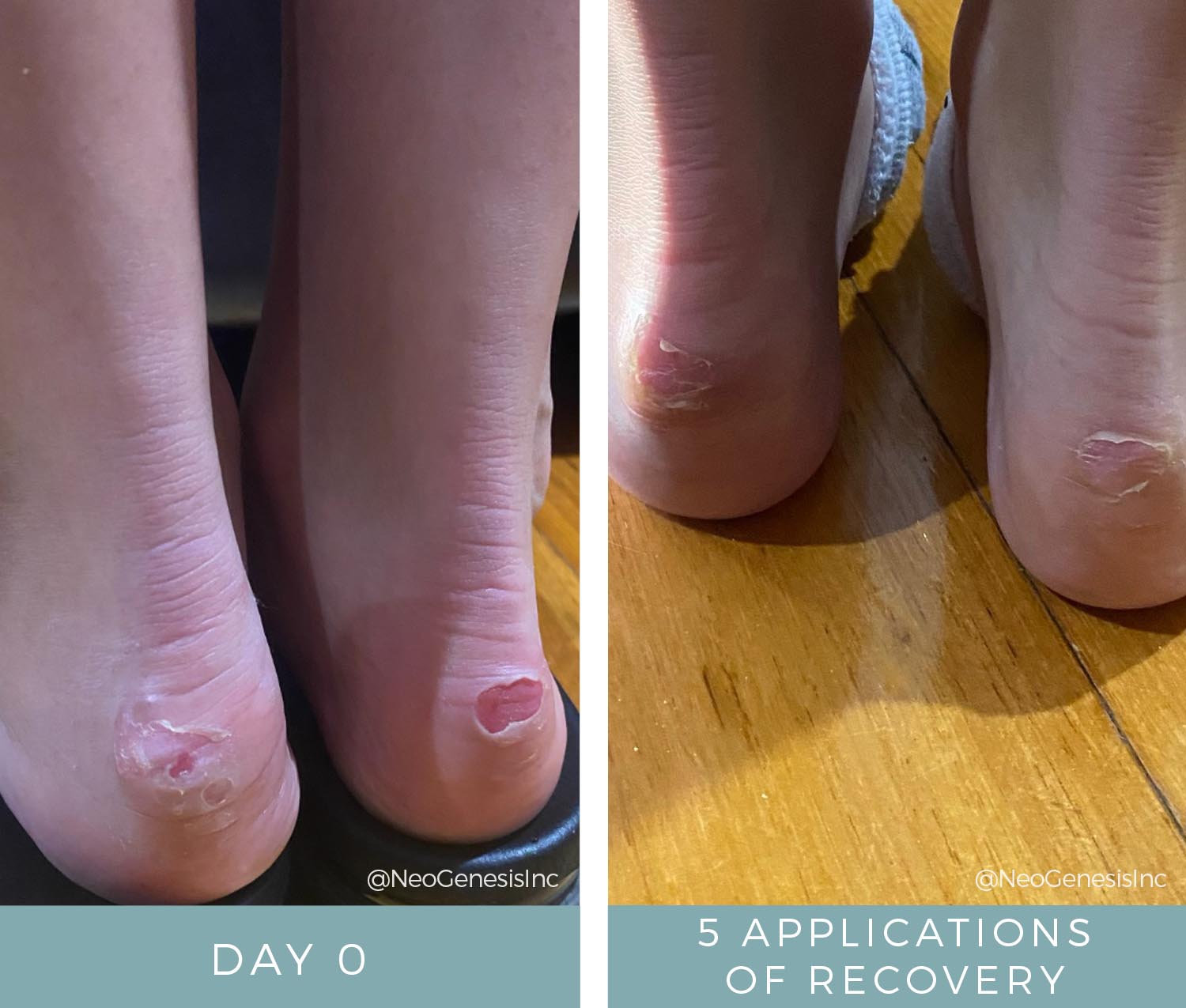 Before + After - Wound Care - Ballerina Blisters