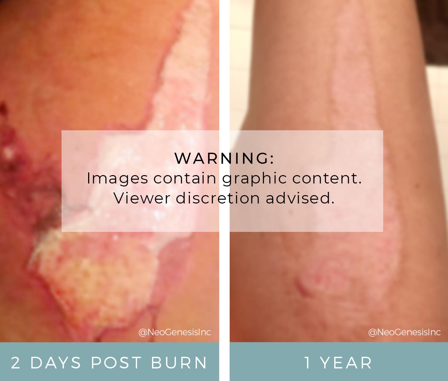 Before + After - Wound Care - Hot Oil Burn