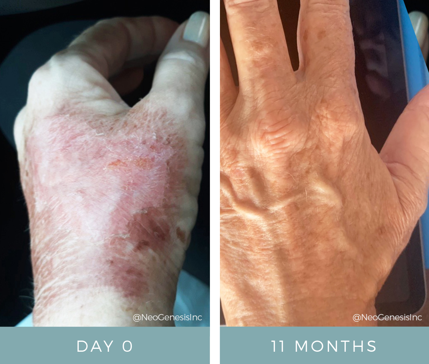 Before + After - Wound Care - Boiling Water Burn on Hand