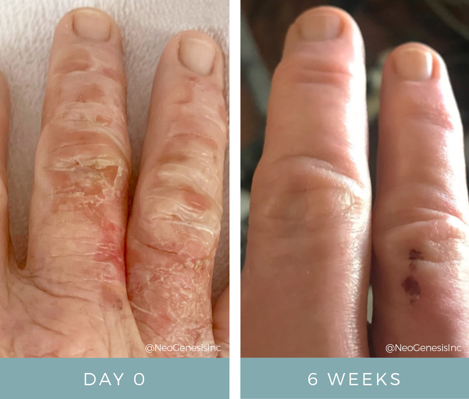 Before + After - Wound Care - Boiling Water Burn on Fingers