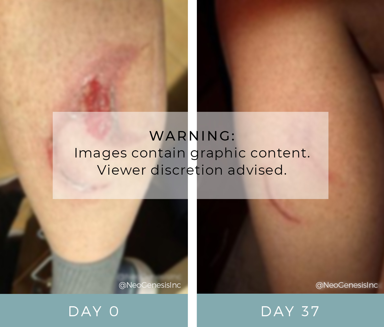 Before + After - Wound Care - Burn