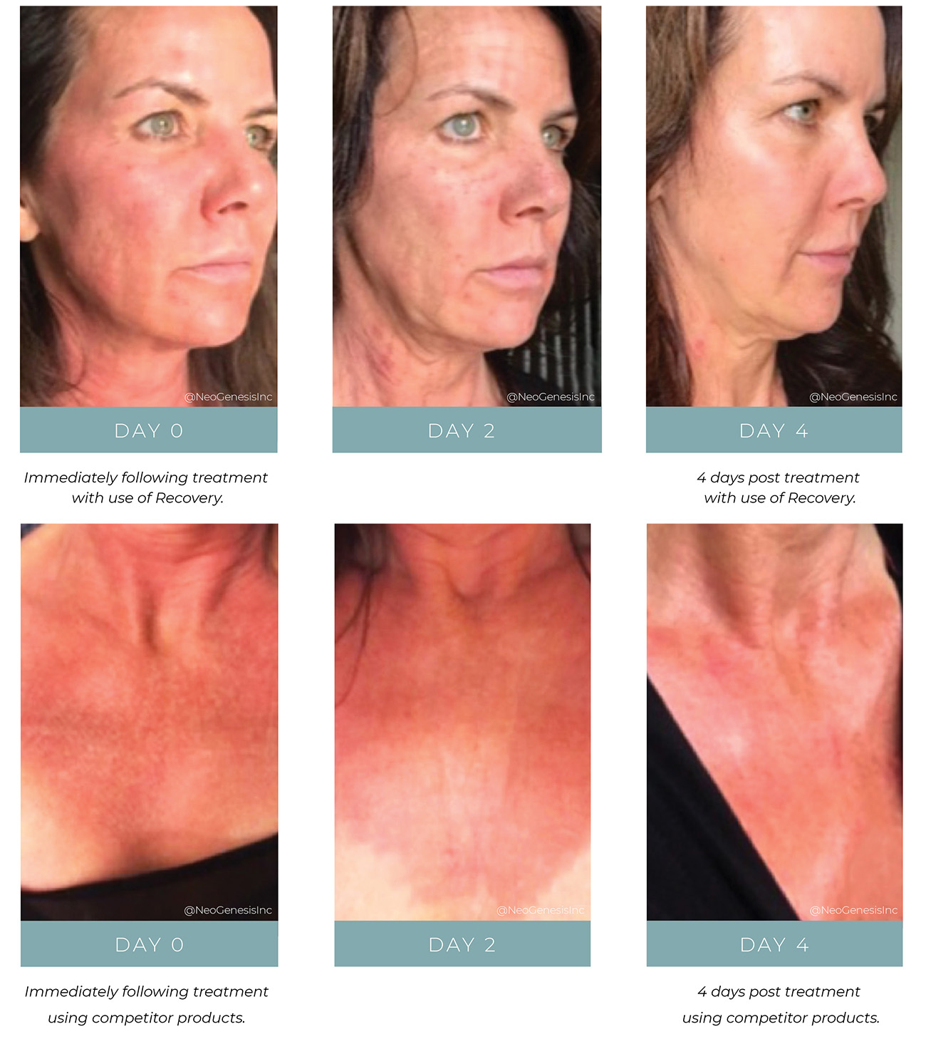 CO2 Laser - Post treatment skin care