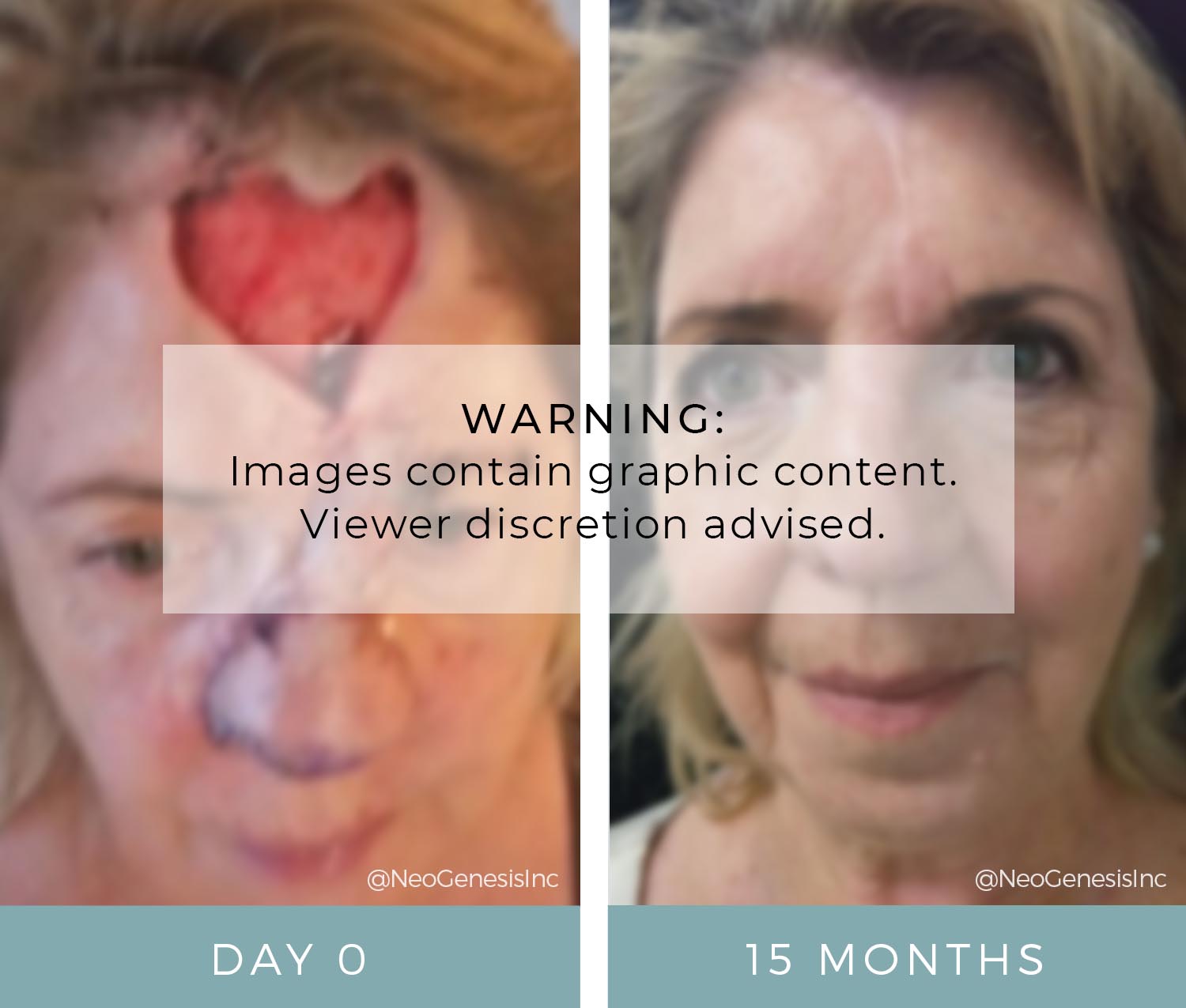 Before + After - Cancer Surgery for Basal Cell Carcinoma