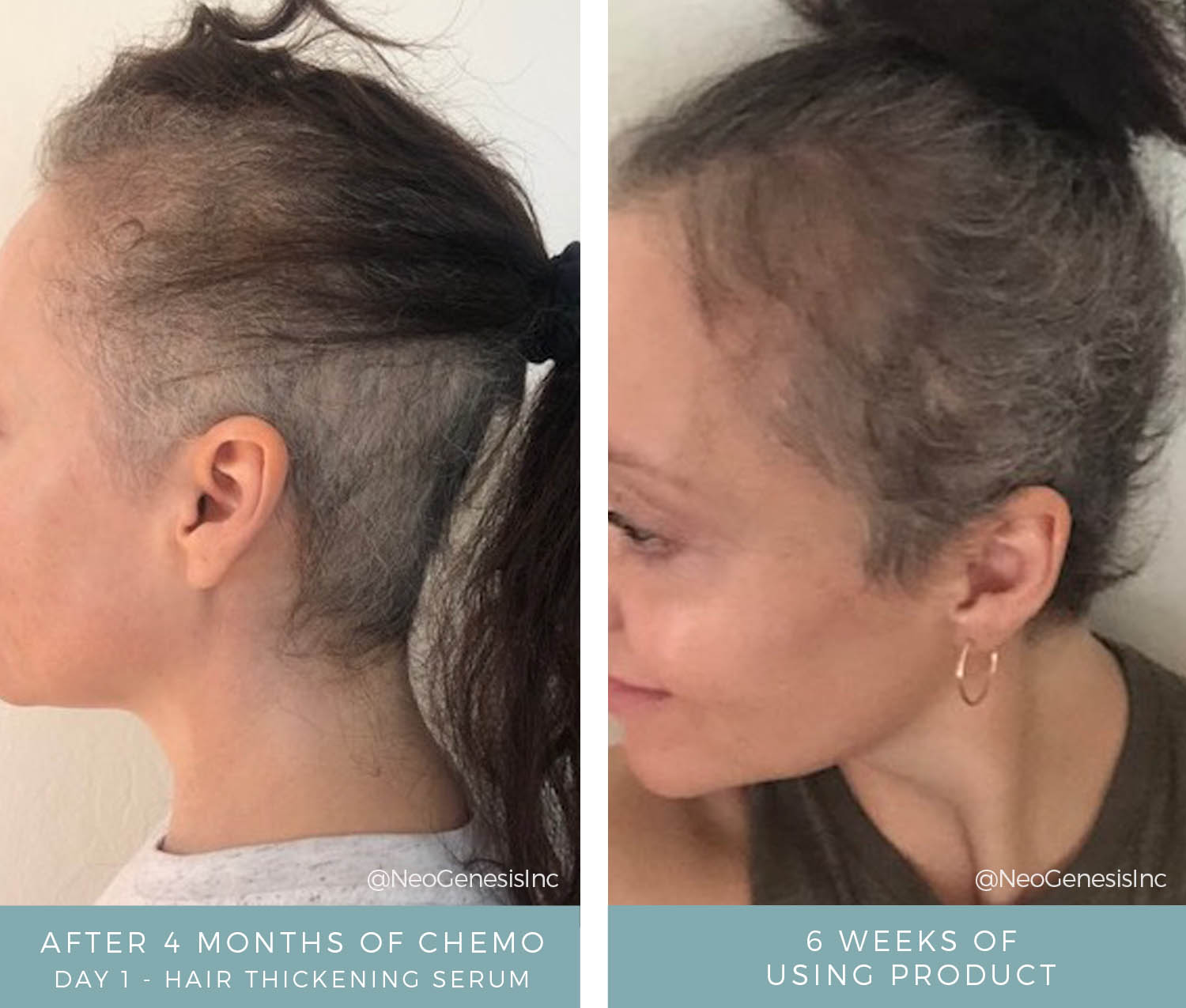 Before + After - Hair + Lash + Brow Loss from Chemo
