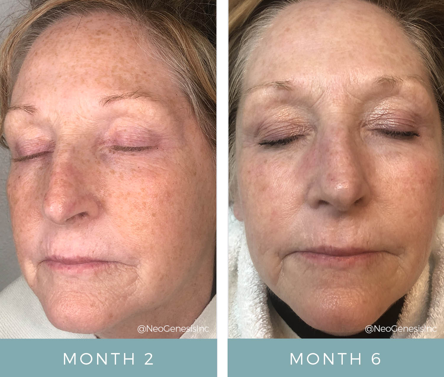 Before + After - Chronic Dry Skin from Chemo