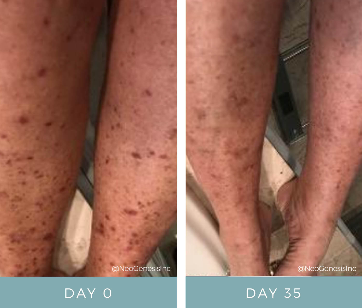 Before + After - Chemo Rash