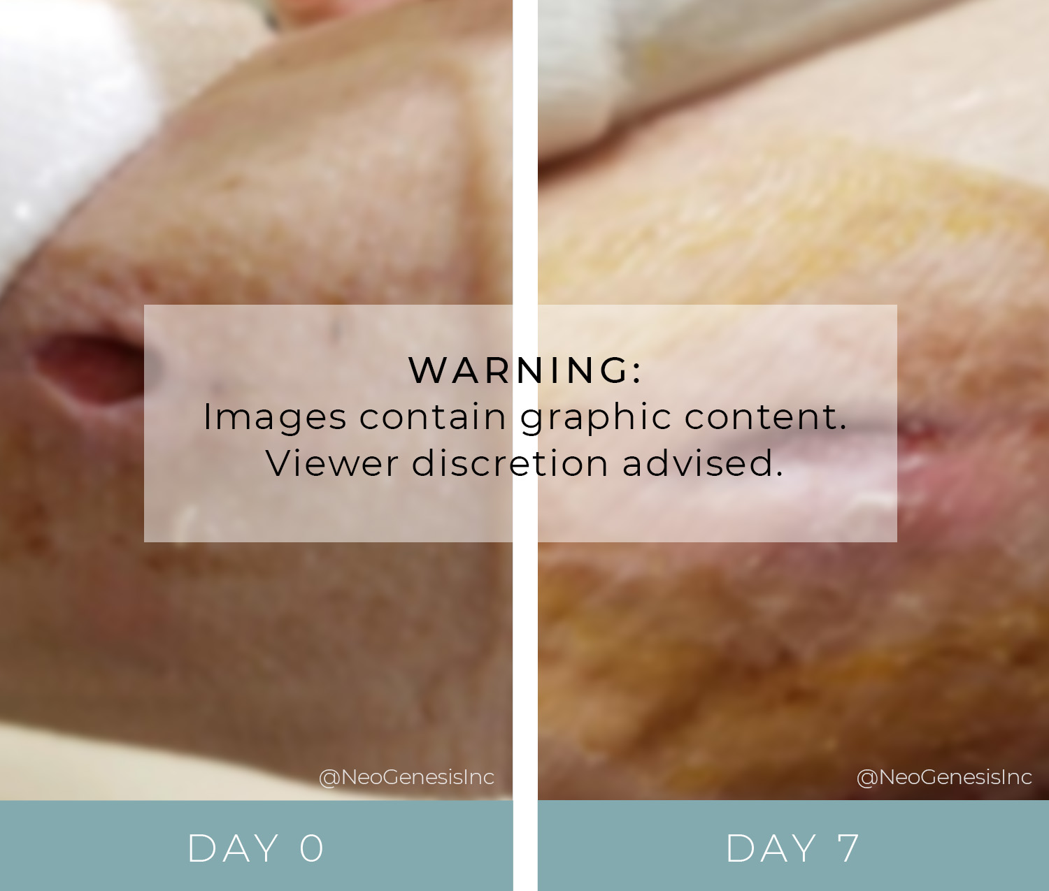 Before + After - Wound Care - Diabetic Ulcer