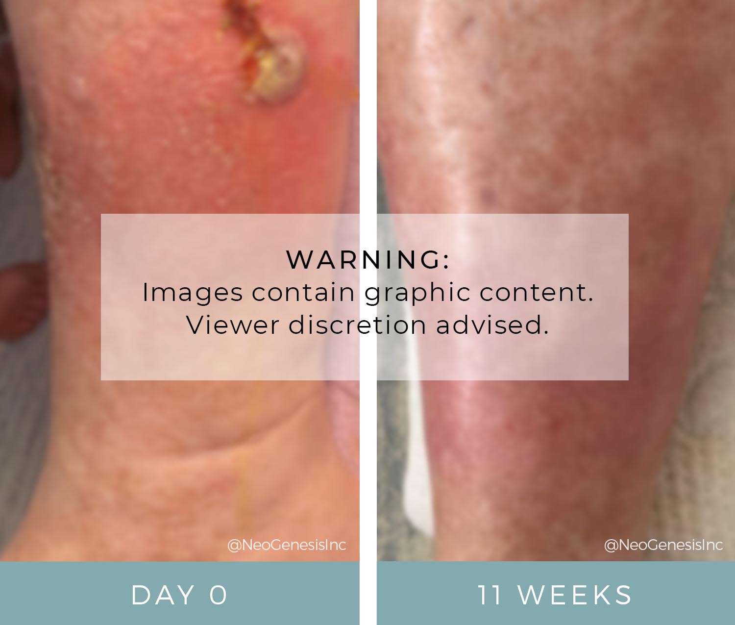 Before + After - Wound Care - Diabetic Ulcer