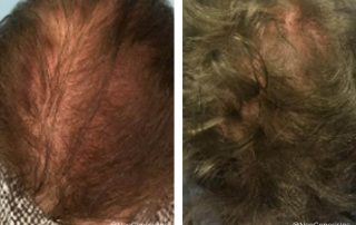 Before + After - Hair Loss + Thinning