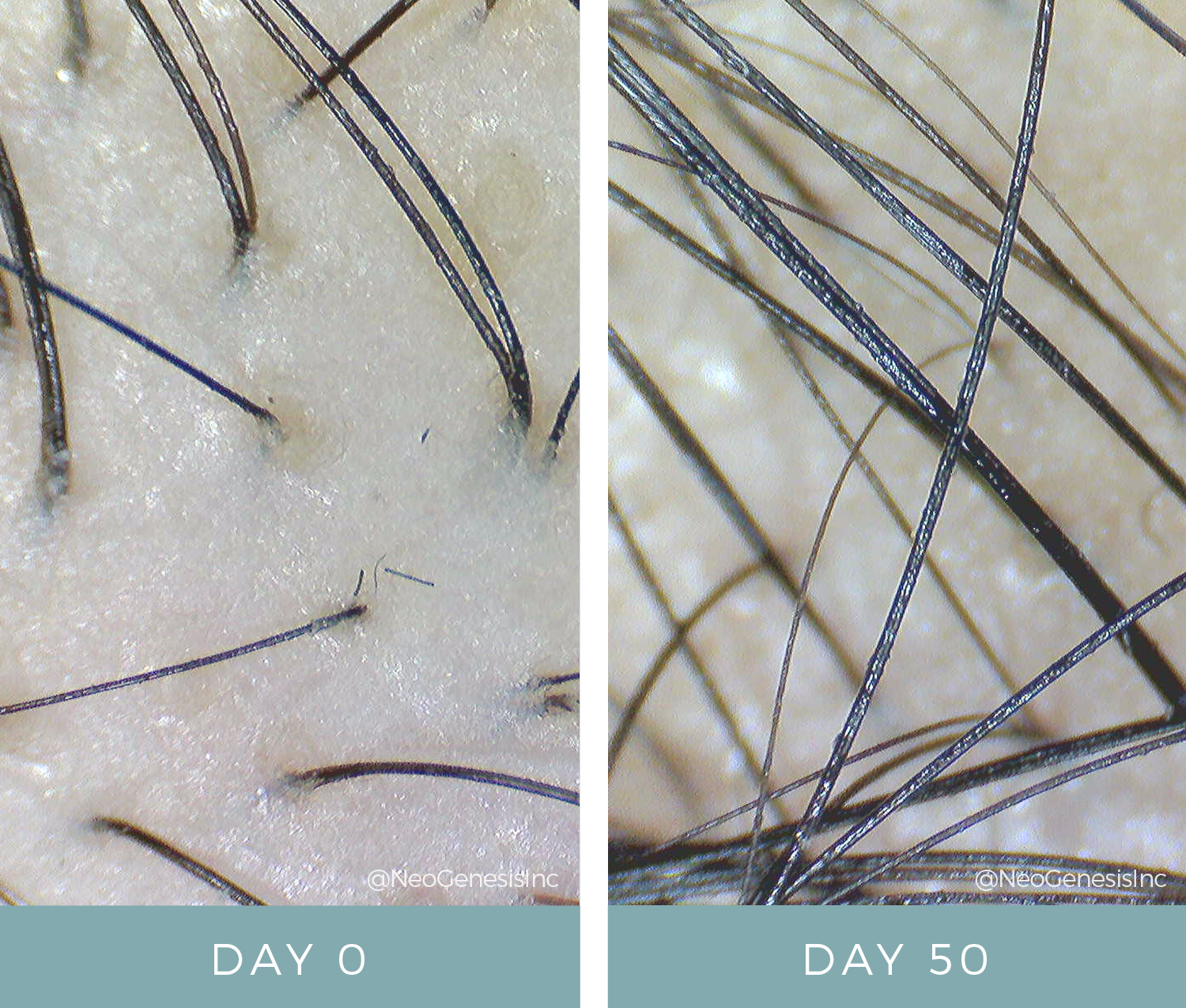 Before + After - Hair Loss + Microneedling