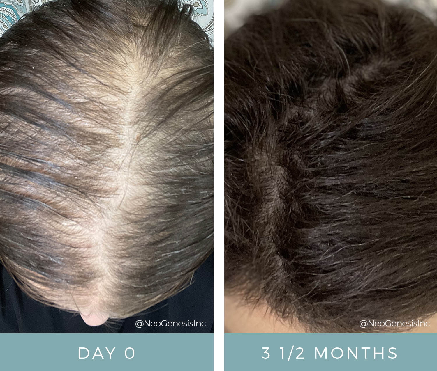 Before + After - Hair Loss from Chemo