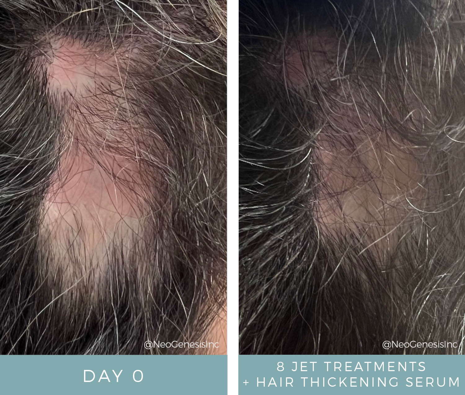 Before + After - Hair Loss + JET Treatments